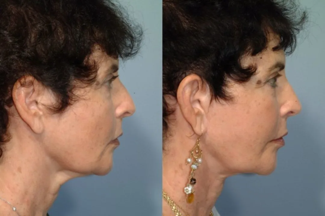 Before and after deep plane facelift — 58-year-old woman, left profile view, 6mo post-op by Dr. Steven Pearlman