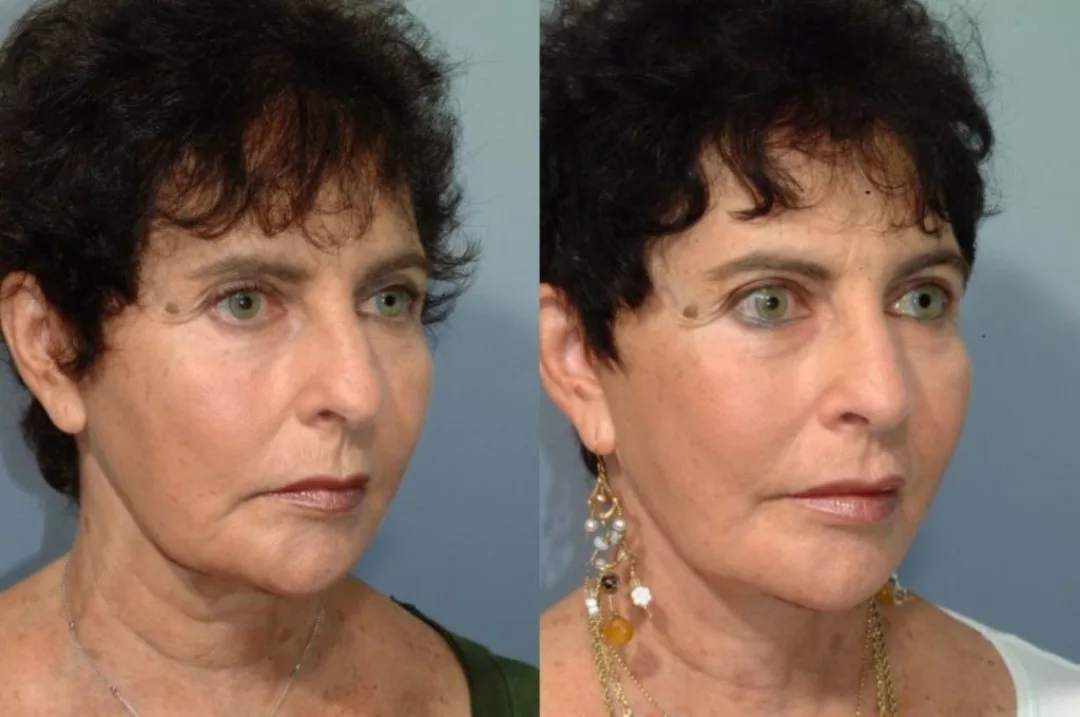Before and after deep plane facelift — 58-year-old woman, oblique right view, 6mo post-op by Dr. Steven Pearlman