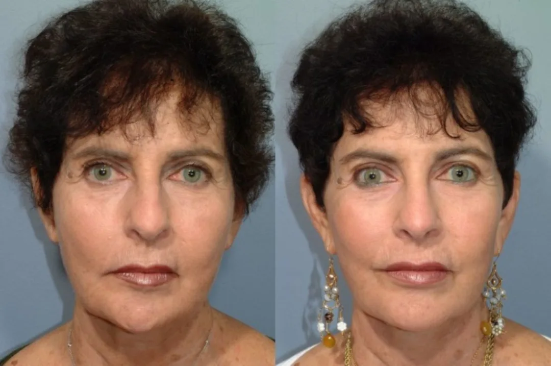 Before and after deep plane facelift — 58-year-old woman, frontal view, 7mo post-op by Dr. Steven Pearlman