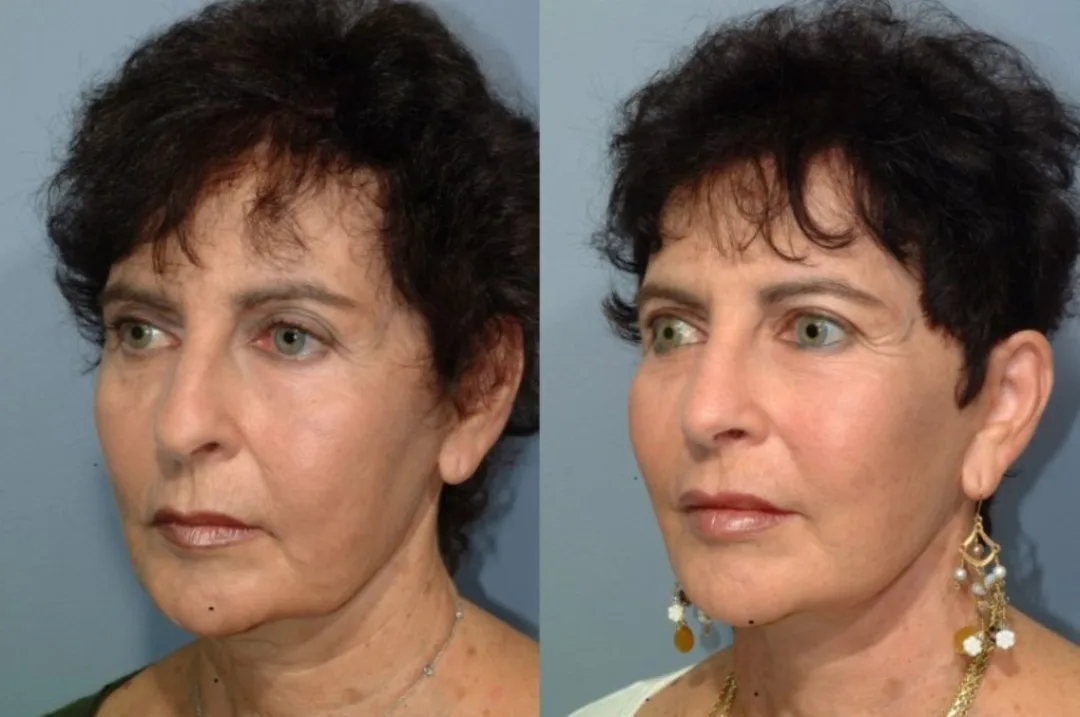 Before and after deep plane facelift — 58-year-old woman, oblique left view, 9mo post-op by Dr. Steven Pearlman