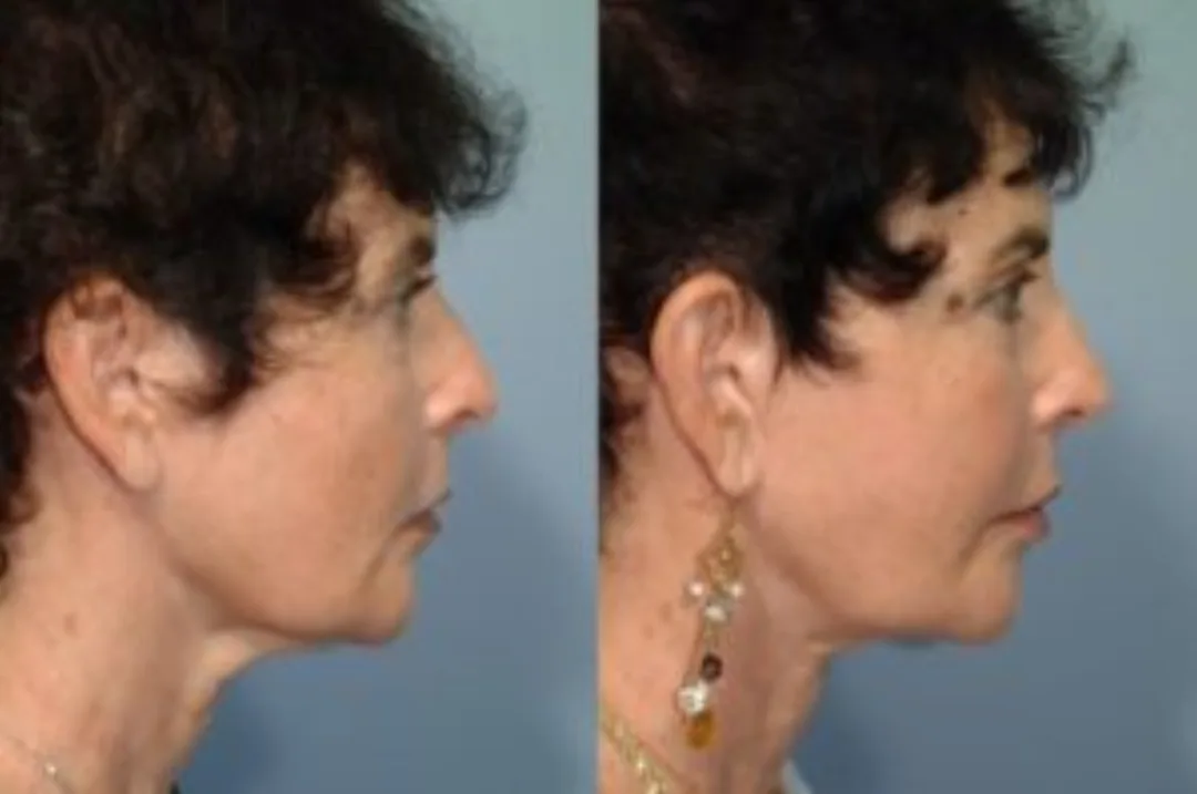Before and after deep plane facelift — 58-year-old woman, right profile view, 6mo post-op by Dr. Steven Pearlman