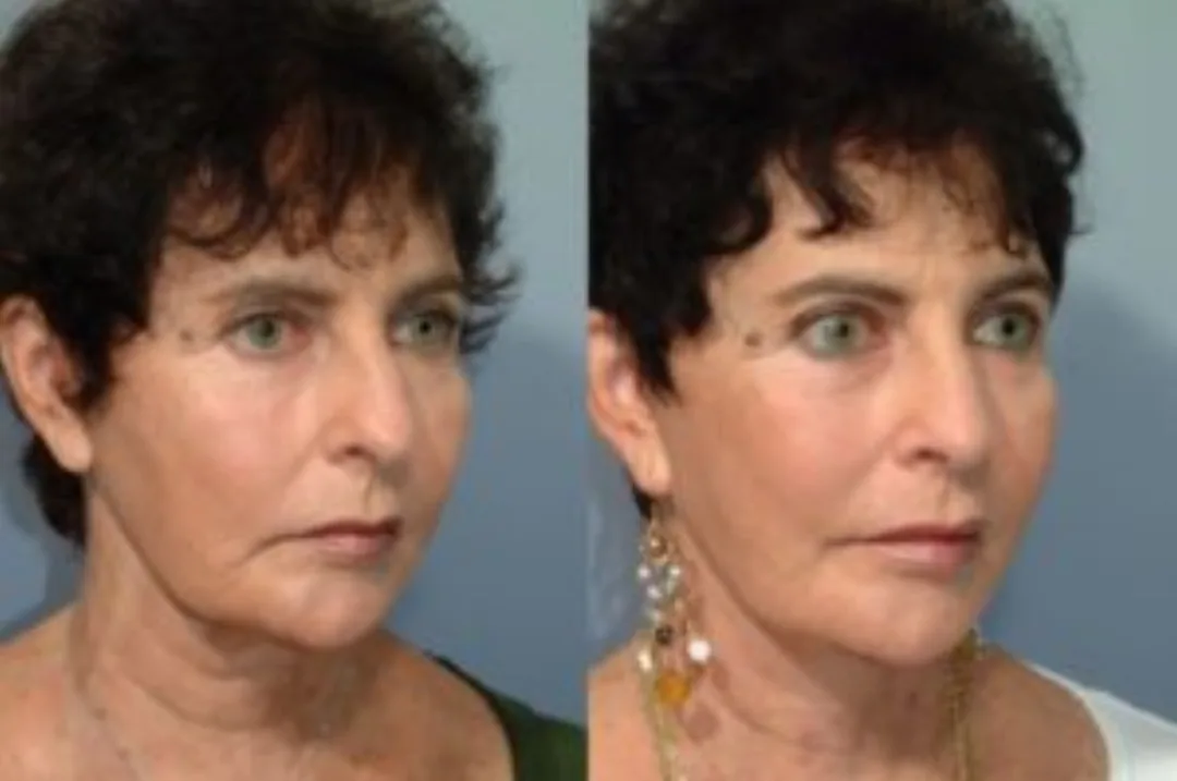 Before and after deep plane facelift — 55-year-old woman, oblique right view, 6mo post-op by Dr. Steven Pearlman