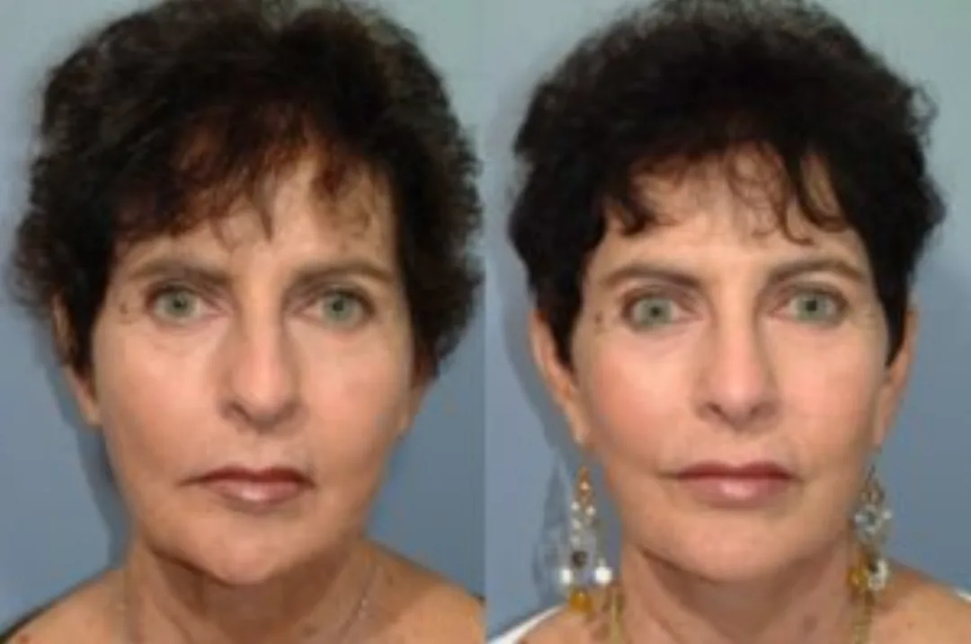 Before and after deep plane facelift — 55-year-old woman, frontal view, 8mo post-op by Dr. Steven Pearlman