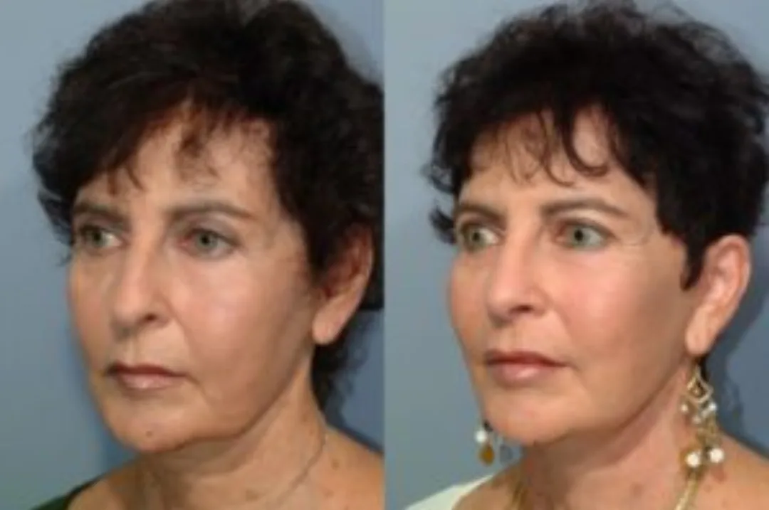 Before and after deep plane facelift — 52-year-old woman, oblique left view, 6mo post-op by Dr. Steven Pearlman