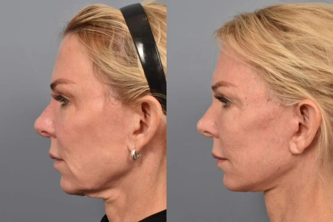 Before and after deep plane facelift — 52-year-old woman, left profile view, 7mo post-op by Dr. Steven Pearlman