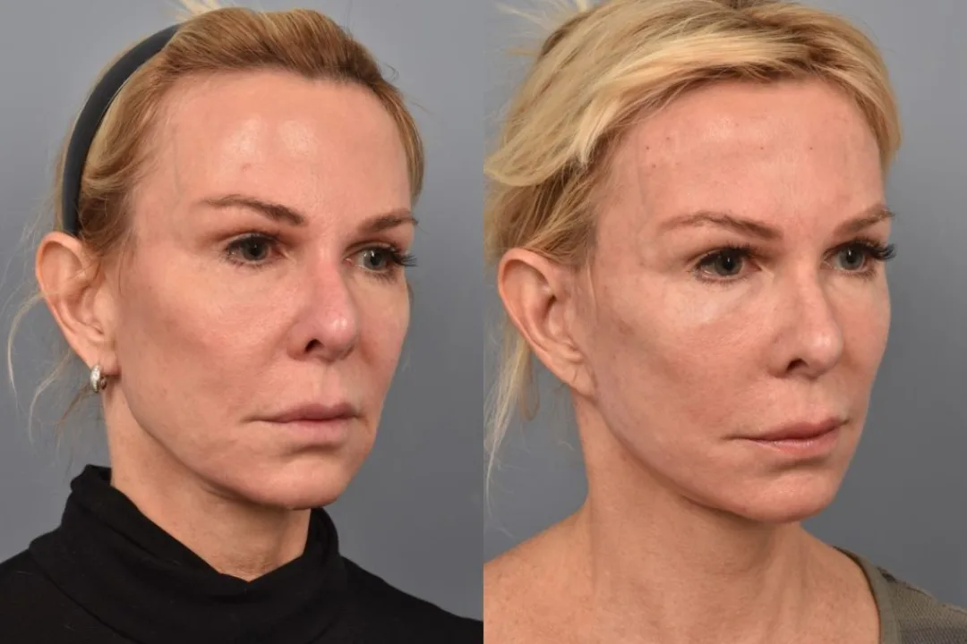 Before and after deep plane facelift — 52-year-old woman, oblique right view, 6mo post-op by Dr. Steven Pearlman