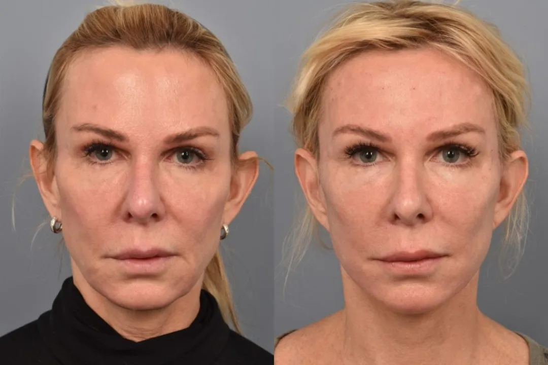 Before and after deep plane facelift — 52-year-old woman, frontal view, 7mo post-op by Dr. Steven Pearlman