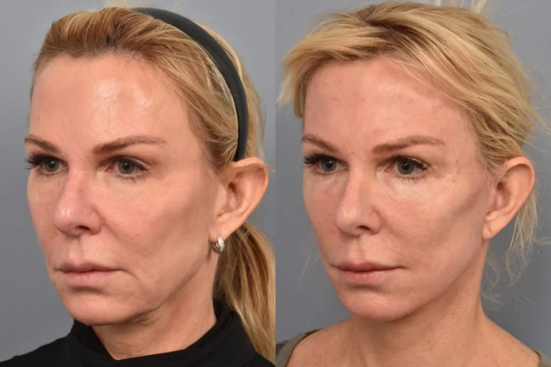Before and after deep plane facelift — 52-year-old woman, oblique left view, 7mo post-op by Dr. Steven Pearlman