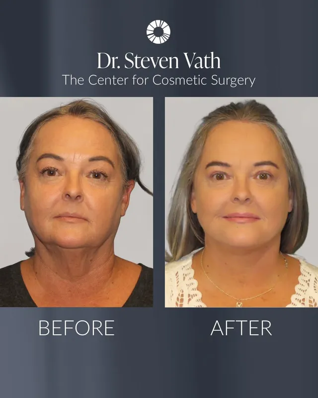 Before and after — Dr. Steven Vath