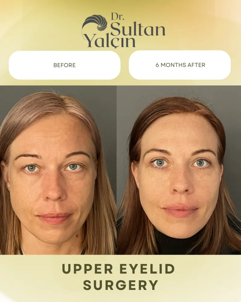 Before and after: Dr. Sultan Yalçın