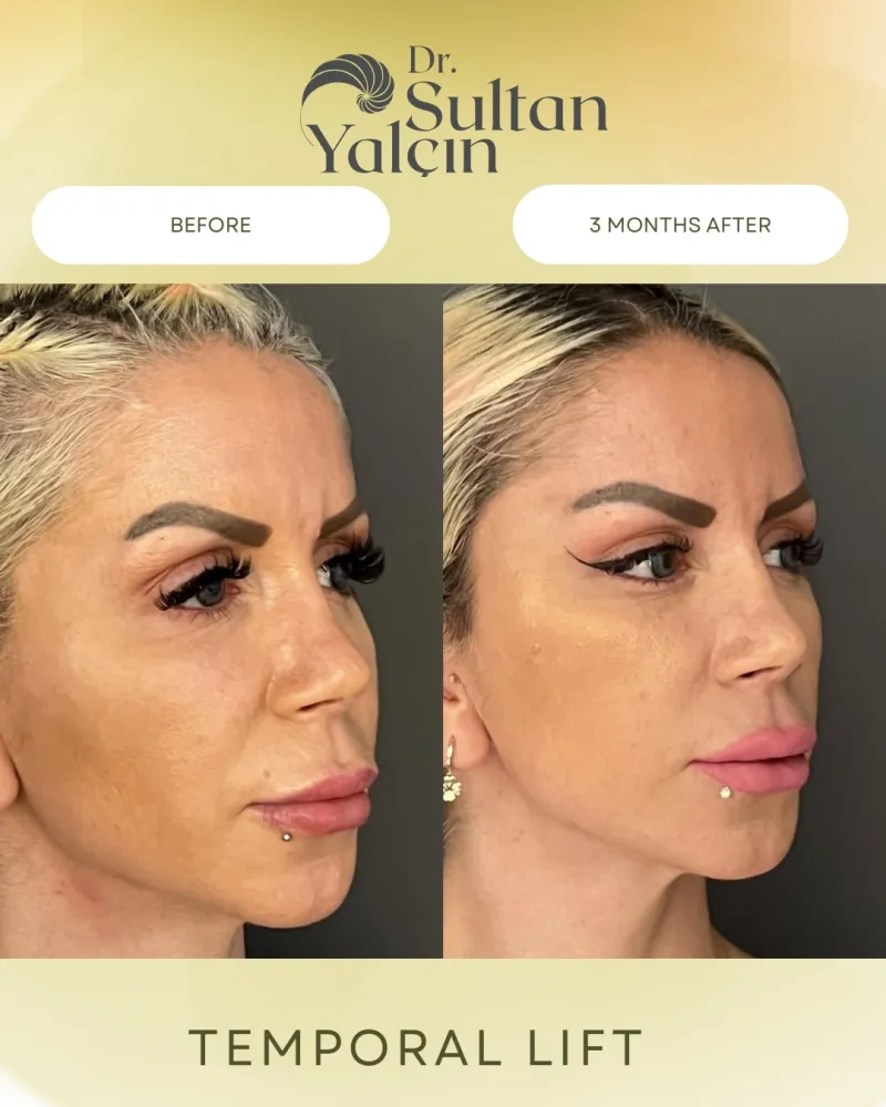 Before and after: Dr. Sultan Yalçın