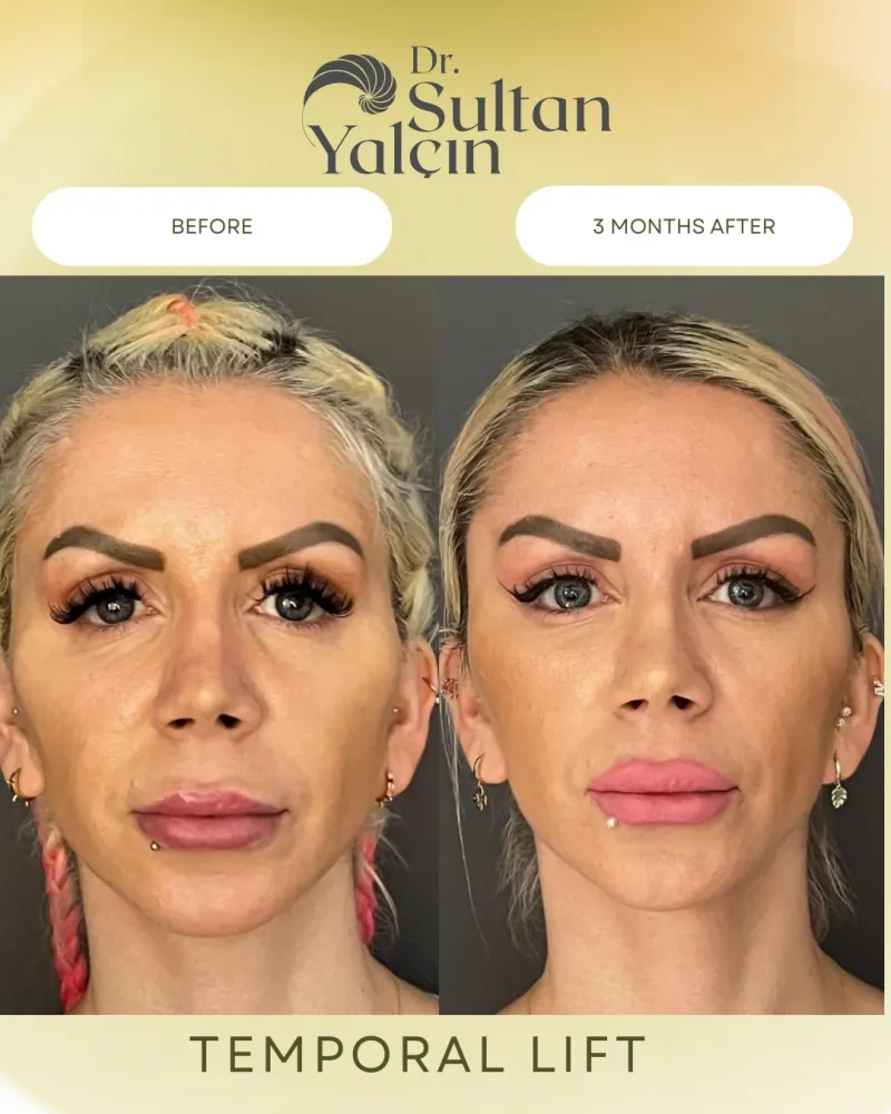 Before and after: Dr. Sultan Yalçın