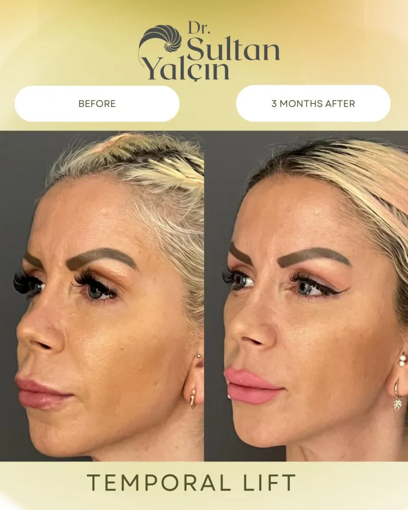 Before and after: Dr. Sultan Yalçın