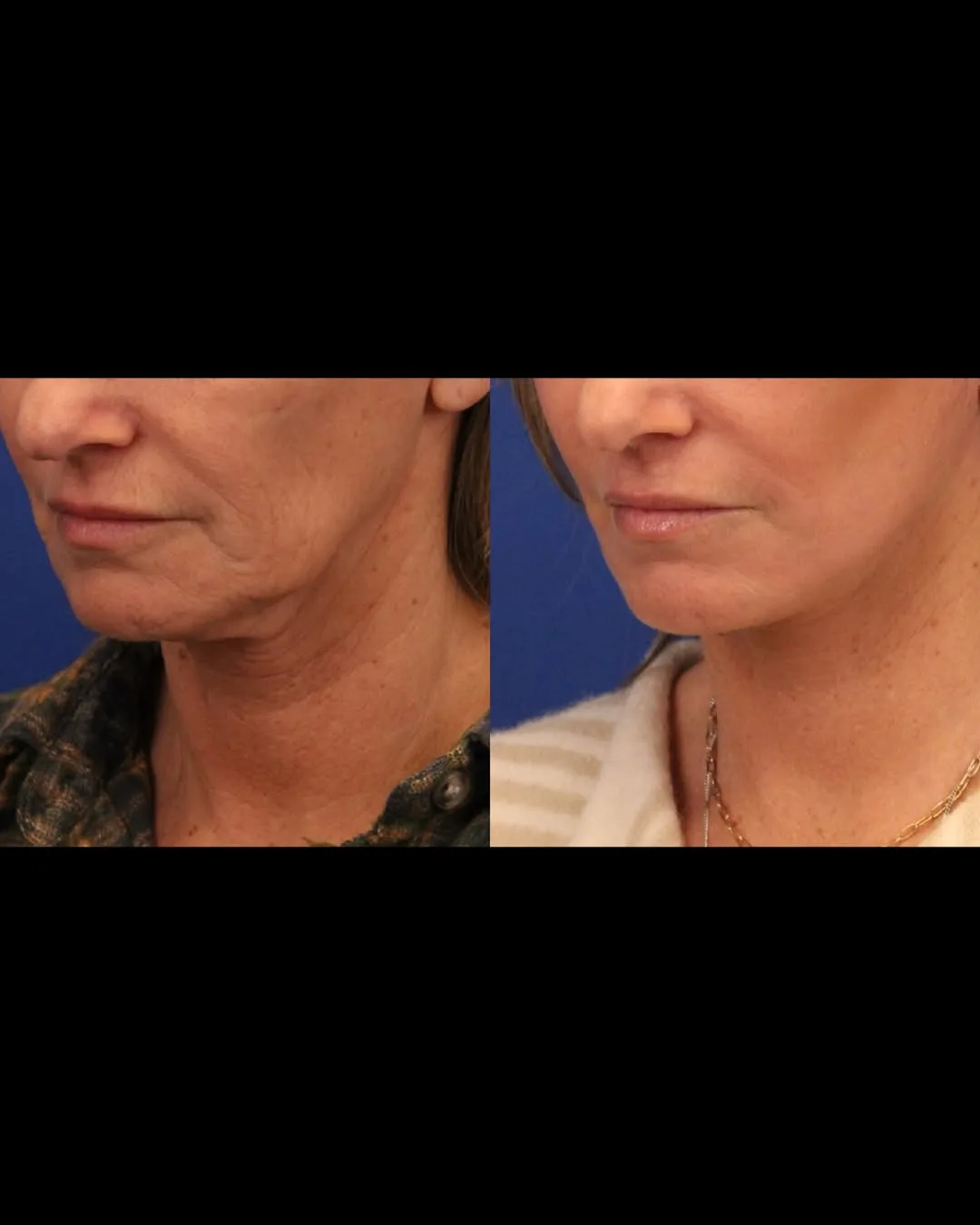 Before and after deep plane facelift — 58-year-old woman, oblique left view, 1mo post-op by Dr. Sumit Bapna