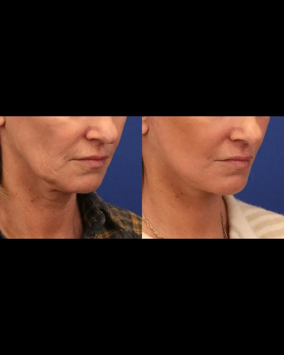Before and after deep plane facelift — 55-year-old woman, three-quarter view, 1mo post-op by Dr. Sumit Bapna