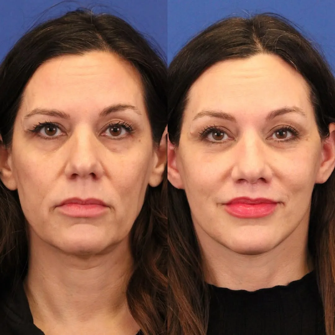 Before and after deep plane facelift — 48-year-old woman, frontal view, 6mo post-op by Dr. Sumit Bapna