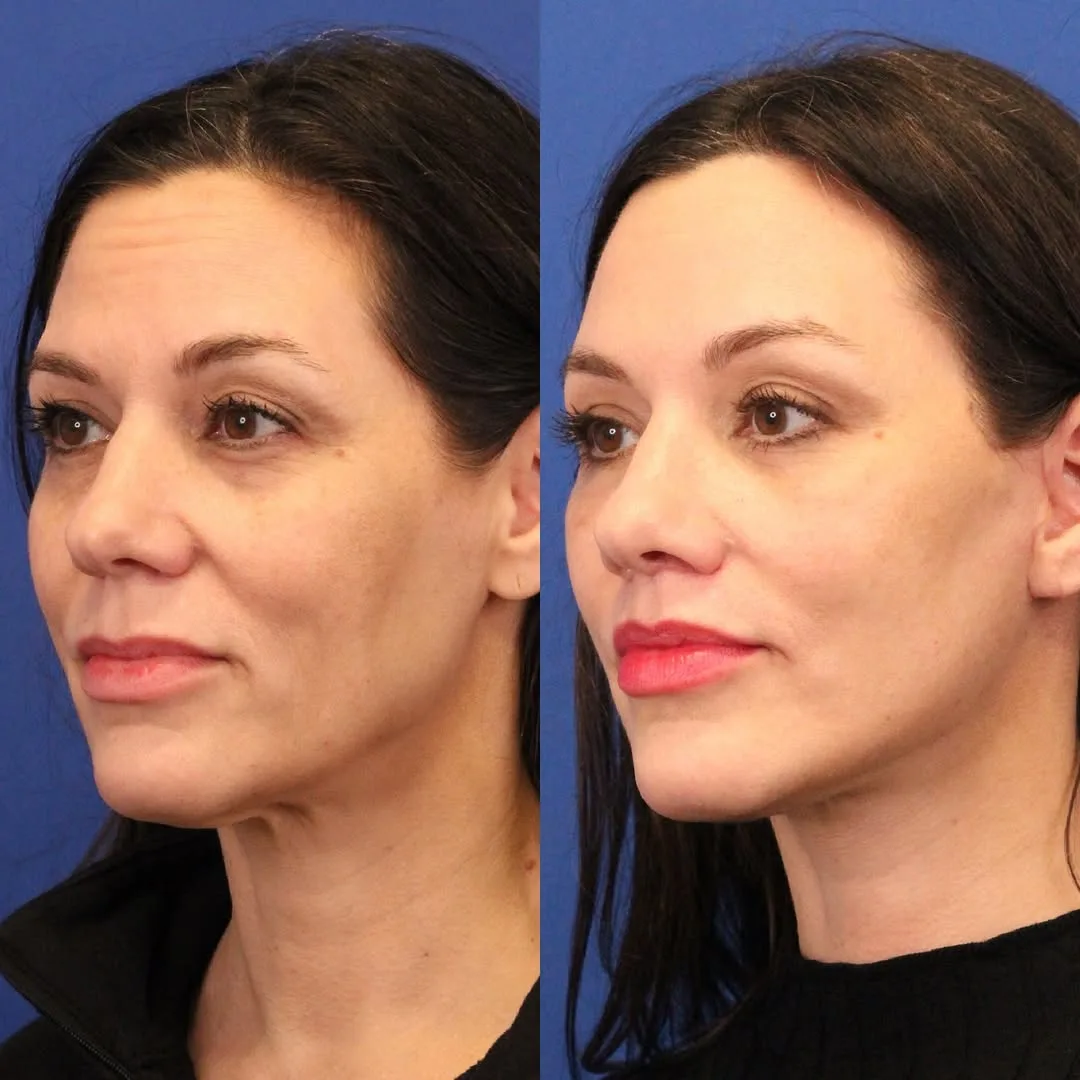 Before and after deep plane facelift — 48-year-old woman, left profile view, 7mo post-op by Dr. Sumit Bapna