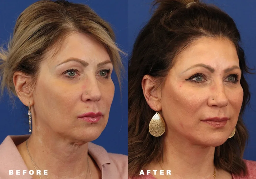 Before and after deep plane facelift — 52-year-old woman, oblique right view, 6mo post-op by Dr. Sumit Bapna