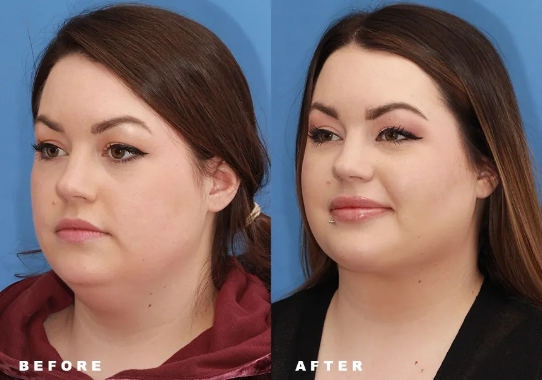 Before and after deep plane facelift — 32-year-old woman, oblique right view, 6mo post-op by Dr. Sumit Bapna