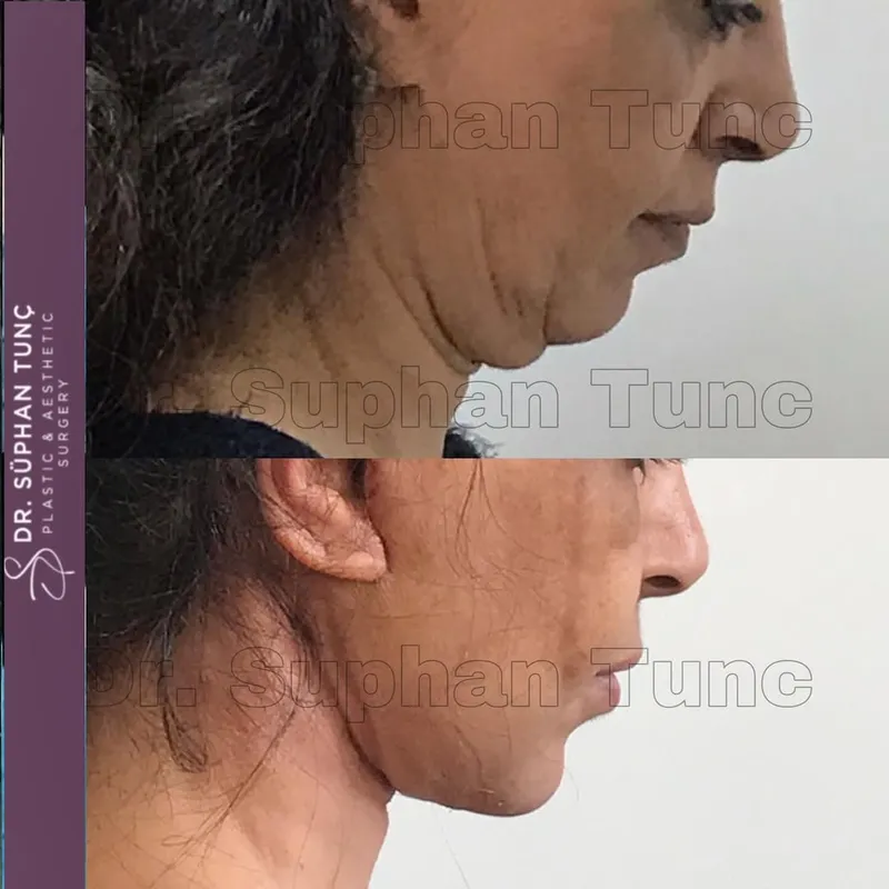 Before and after — Dr. Süphan Tunç