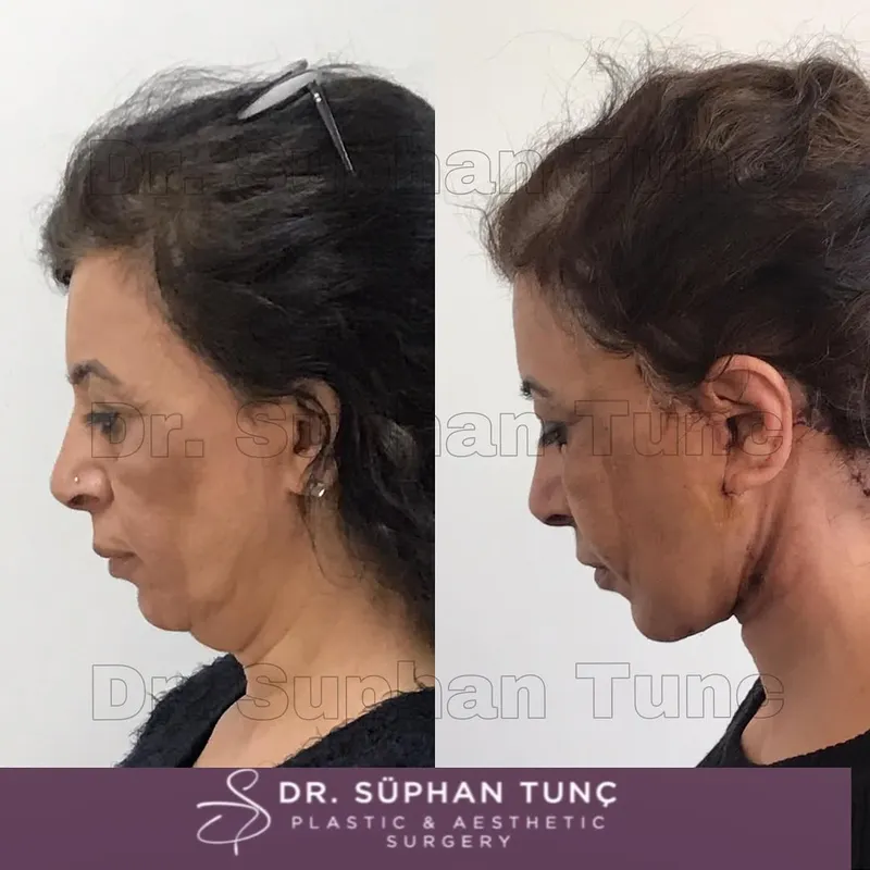 Before and after — Dr. Süphan Tunç
