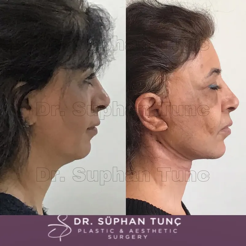 Before and after — Dr. Süphan Tunç