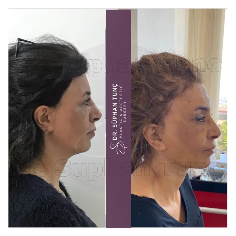 Before and after — Dr. Süphan Tunç