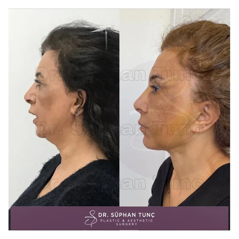 Before and after — Dr. Süphan Tunç