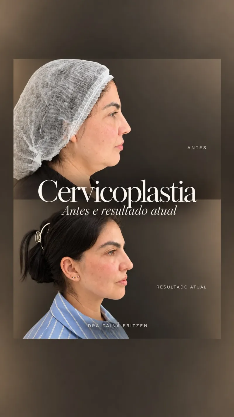 Avant & Après - Deep Plane Facelift par Dr. Tainá Fritzen