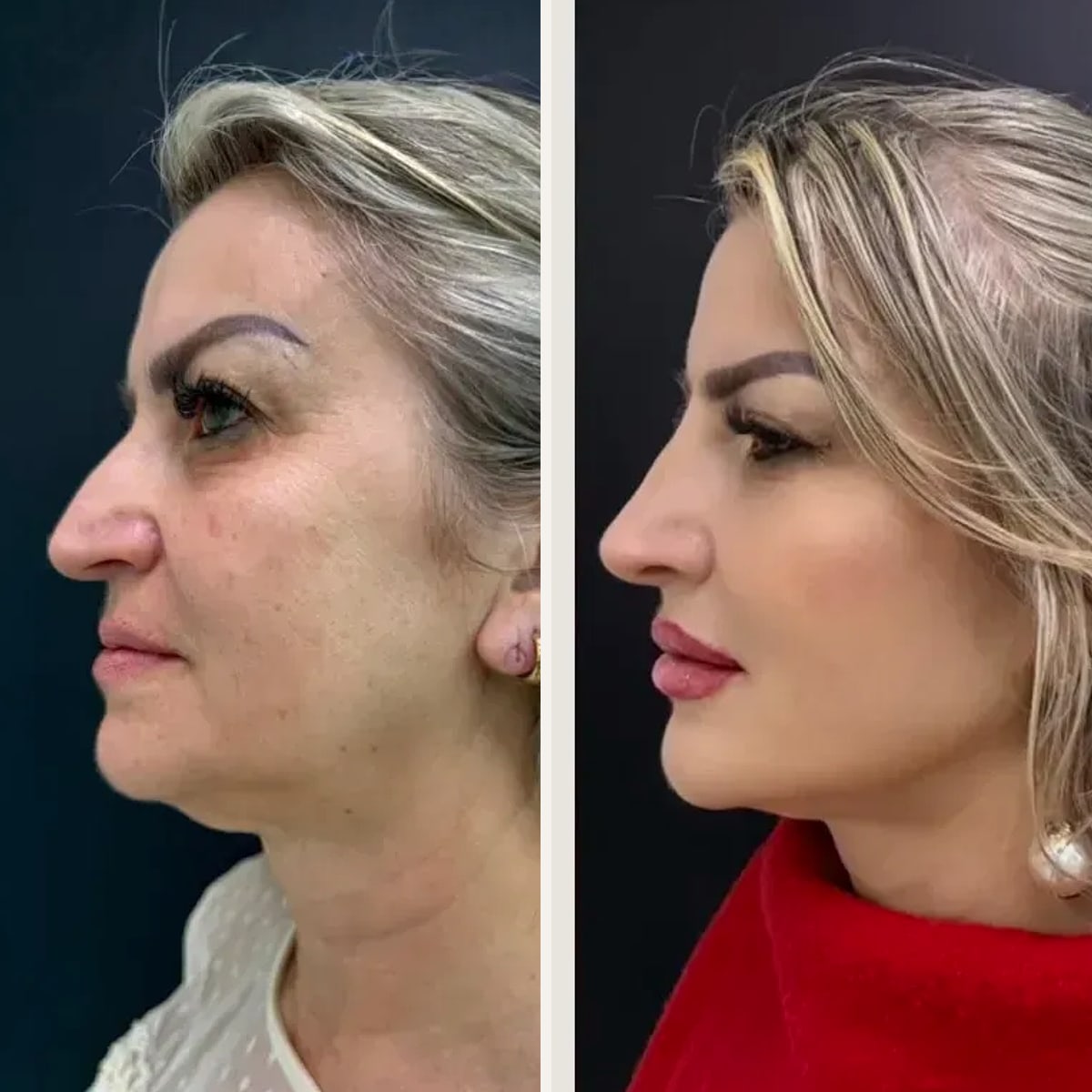 Before and after: Dr. Tainá Fritzen