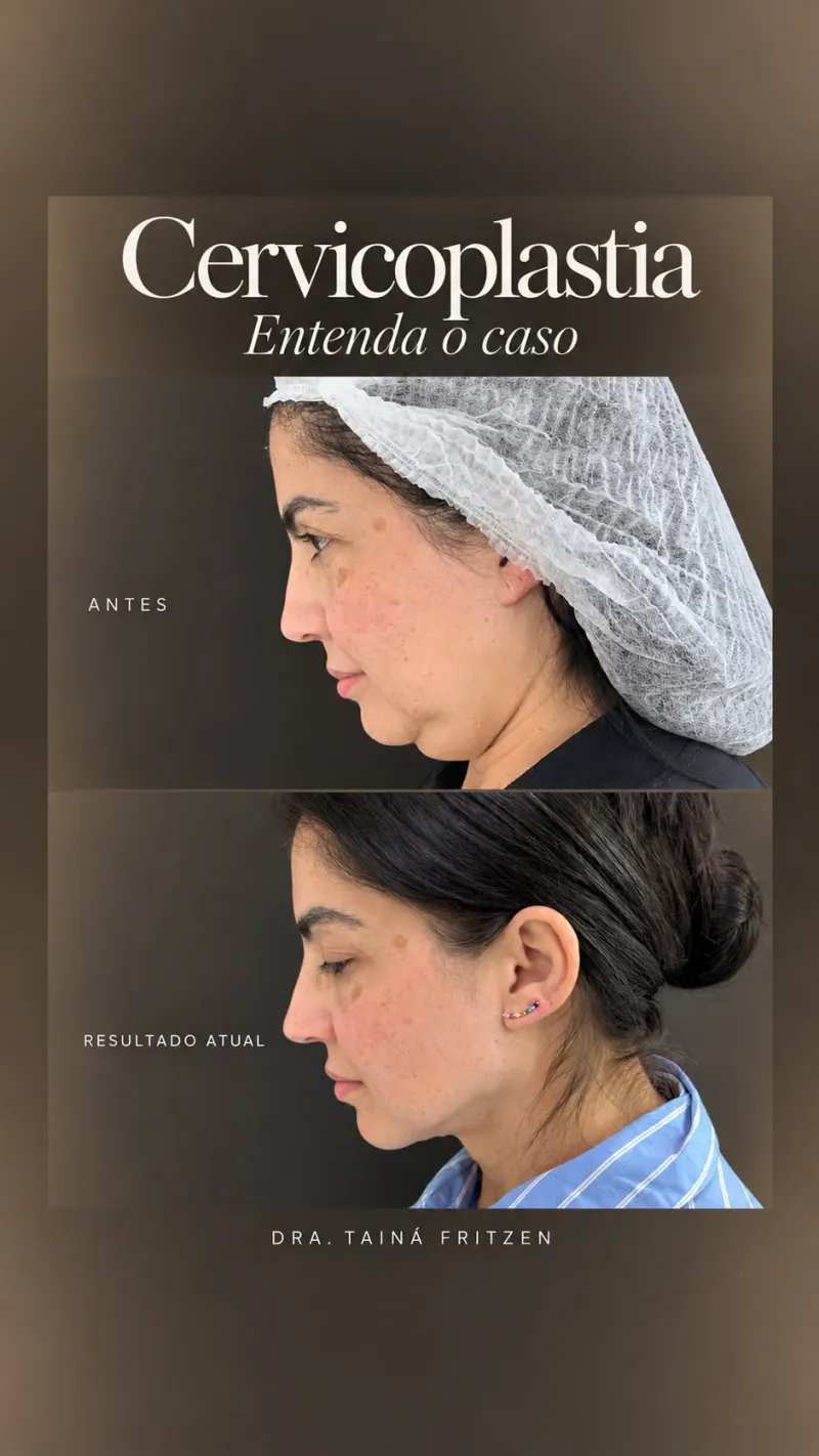 Before and after: Dr. Tainá Fritzen