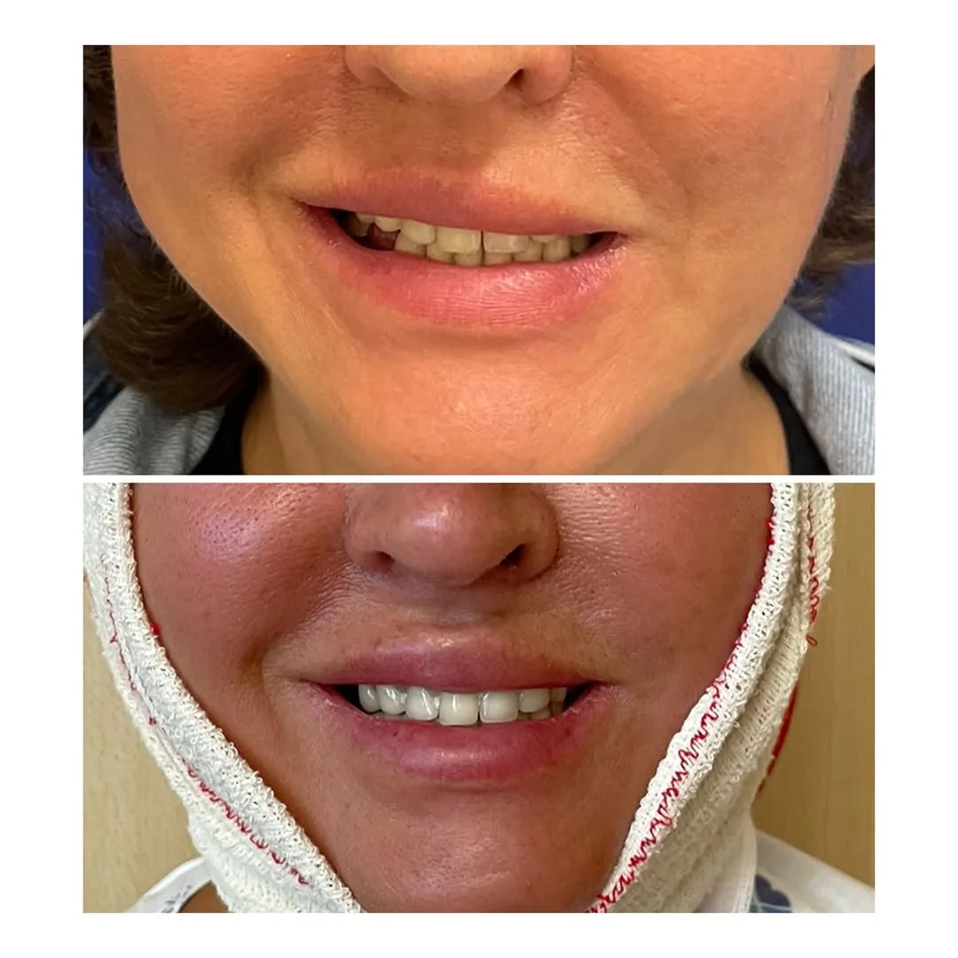 Before and after — Dr. Tal Kaufman Goldberg