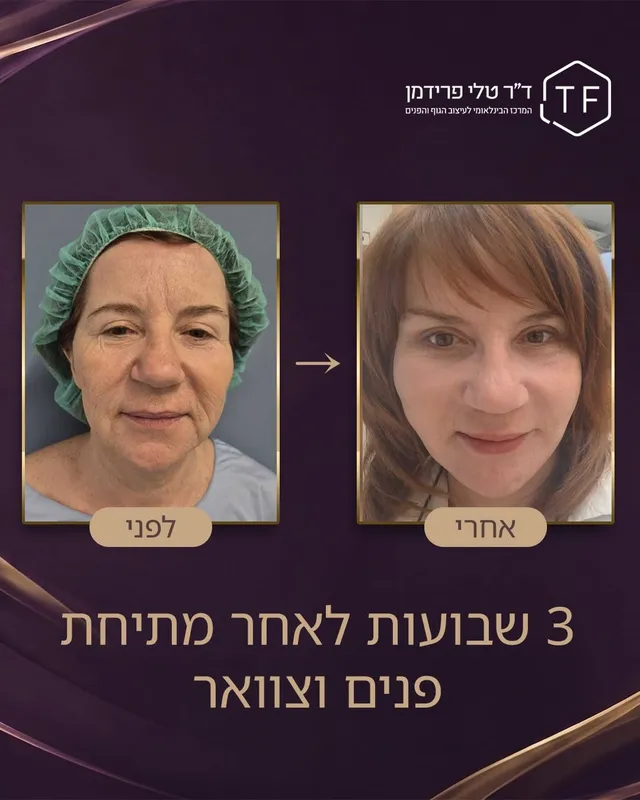 Before and after — Dr. Tali Friedman