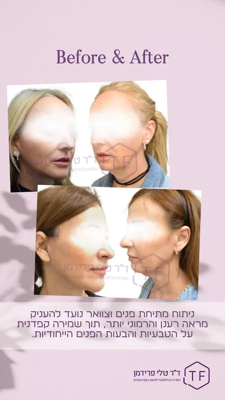 Before and after — Dr. Tali Friedman