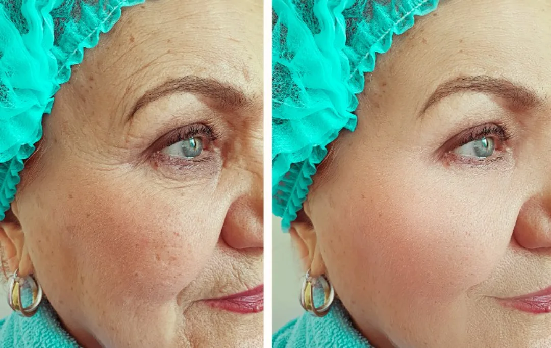 Before and after — Dr. Talih Ahmadie
