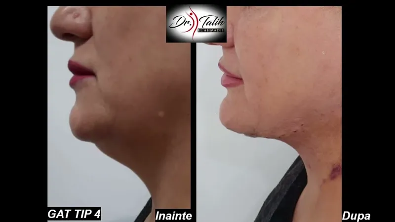 Before and after — Dr. Talih Ahmadie