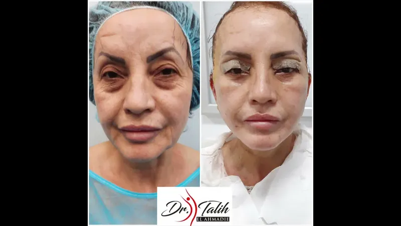 Before and after — Dr. Talih Ahmadie