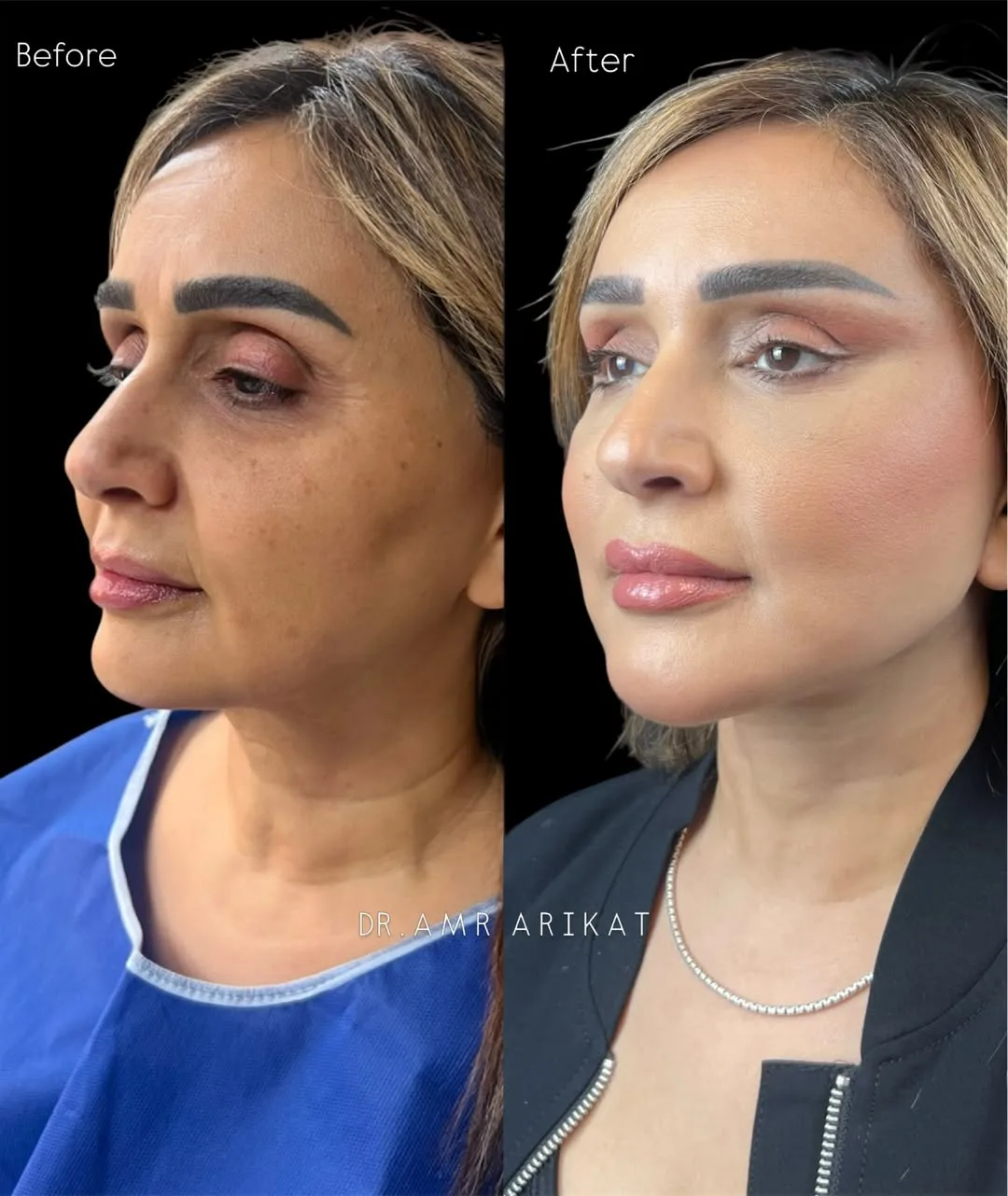 Before and after deep plane facelift — 45-year-old woman, left profile view, 6mo post-op by Dr. Tarek Arikat
