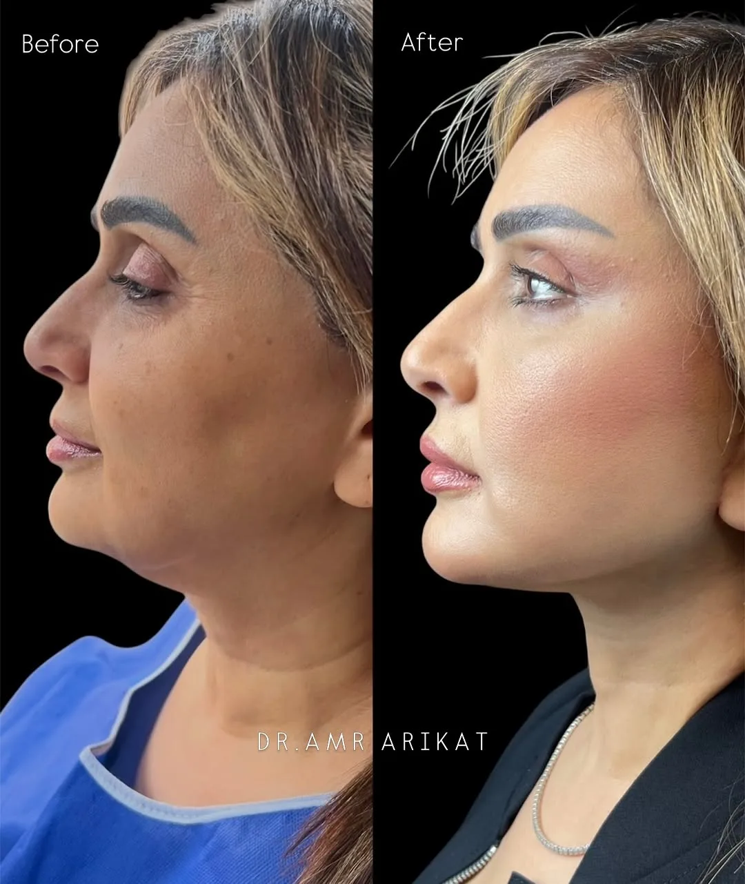Before and after deep plane facelift — 35-year-old woman, left profile view, 6mo post-op by Dr. Tarek Arikat