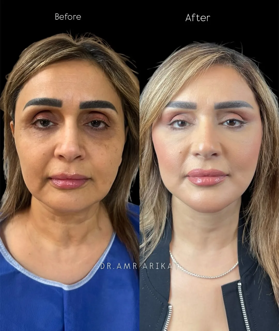 Before and after deep plane facelift — 48-year-old woman, frontal view, 8mo post-op by Dr. Tarek Arikat