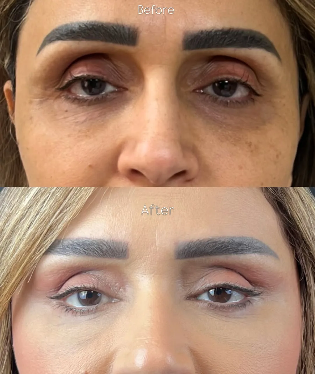 Before and after deep plane facelift — 45-year-old woman, frontal view, 6mo post-op by Dr. Tarek Arikat