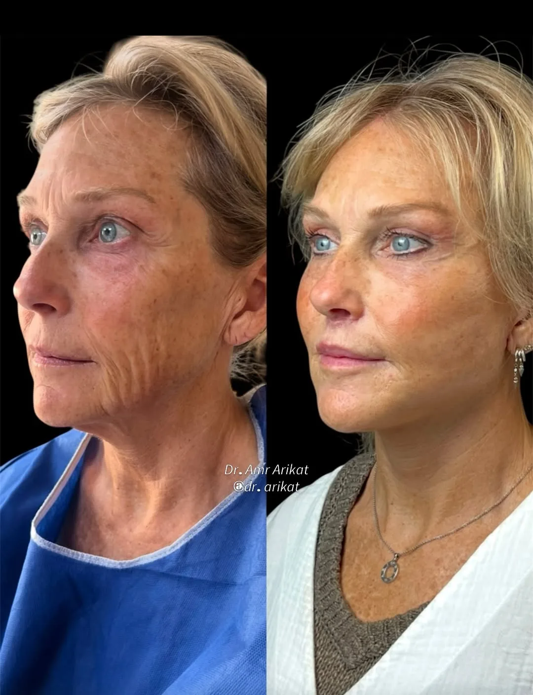 Before and after deep plane facelift — 58-year-old woman, left profile view, 6mo post-op by Dr. Tarek Arikat