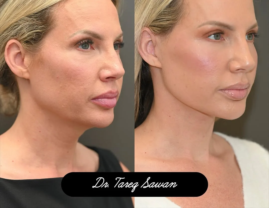 Before and after — Dr. Tareq Sawan
