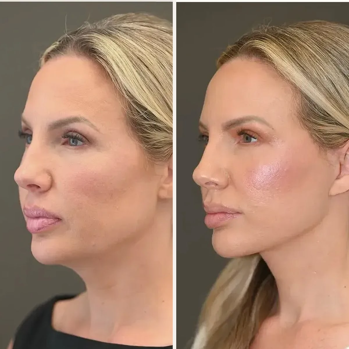 Before and after, Deep Plane Facelift