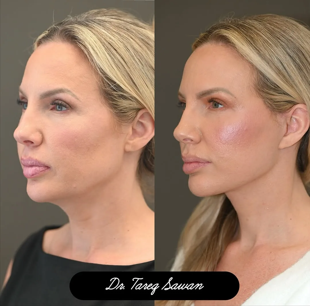 Before and after — Dr. Tareq Sawan