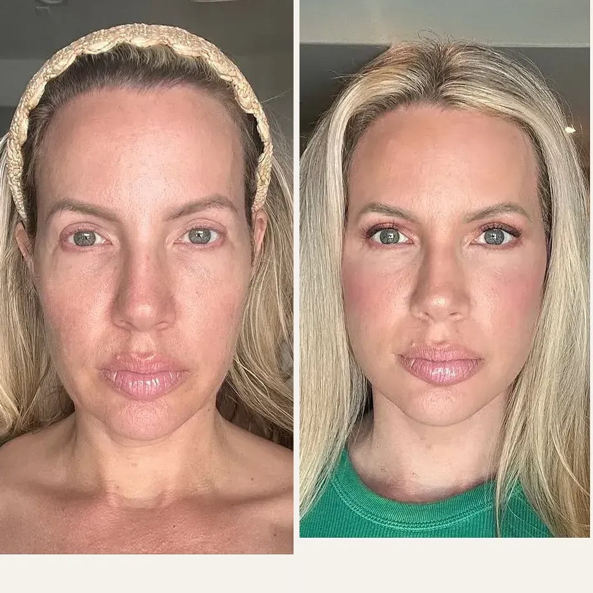 Before and after, Deep Plane Facelift