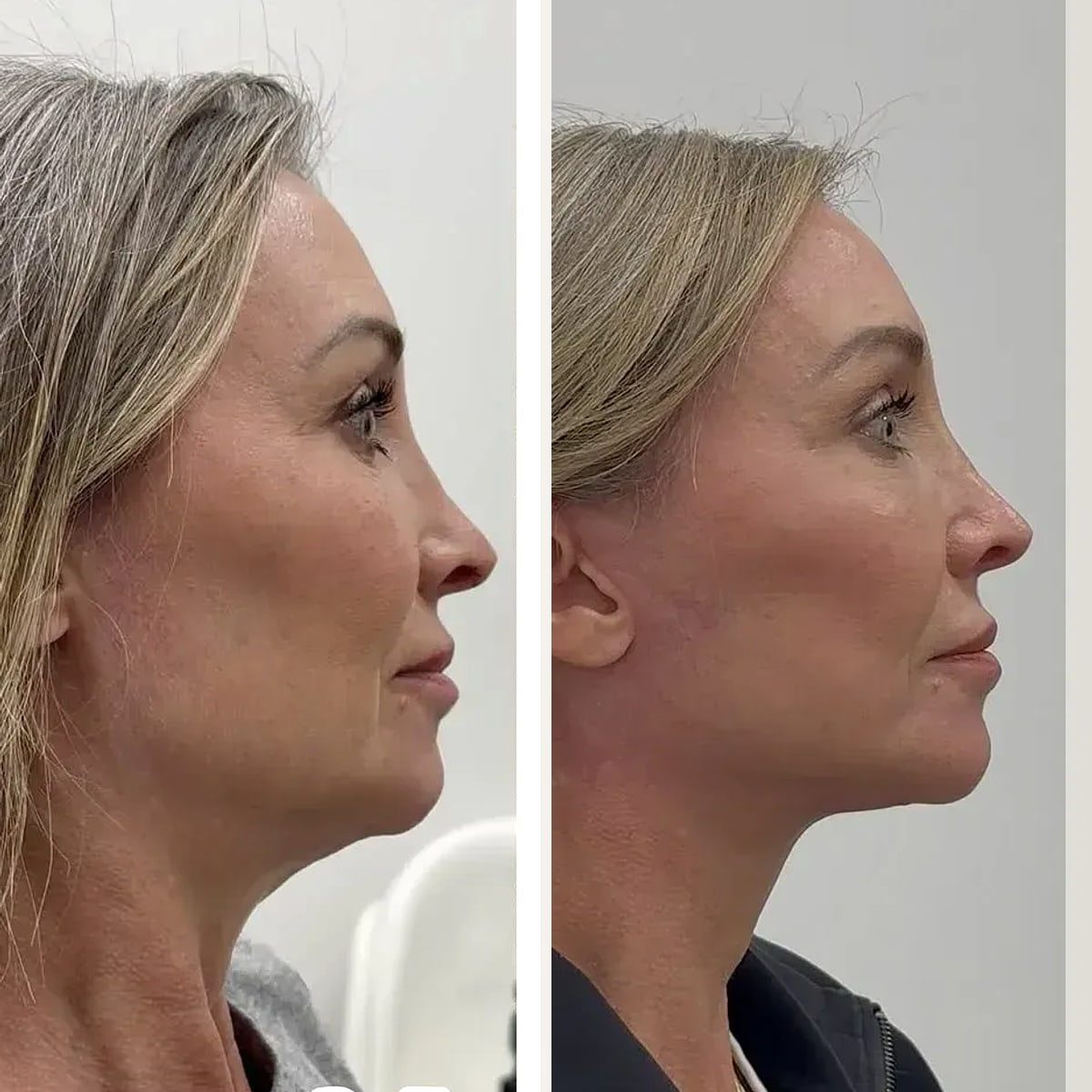 Before and after, Deep Plane Facelift