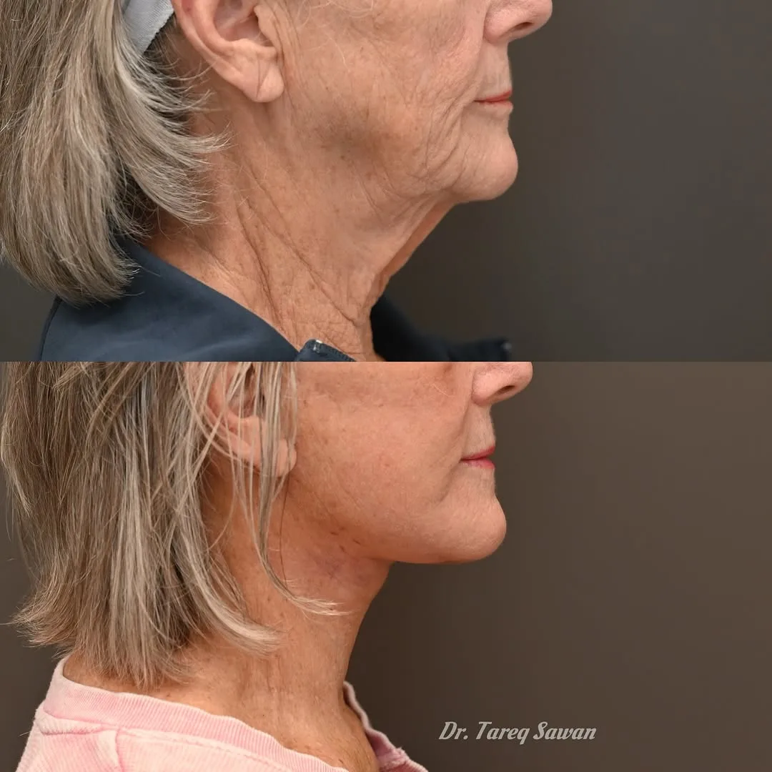 Before and after, Deep Plane Facelift