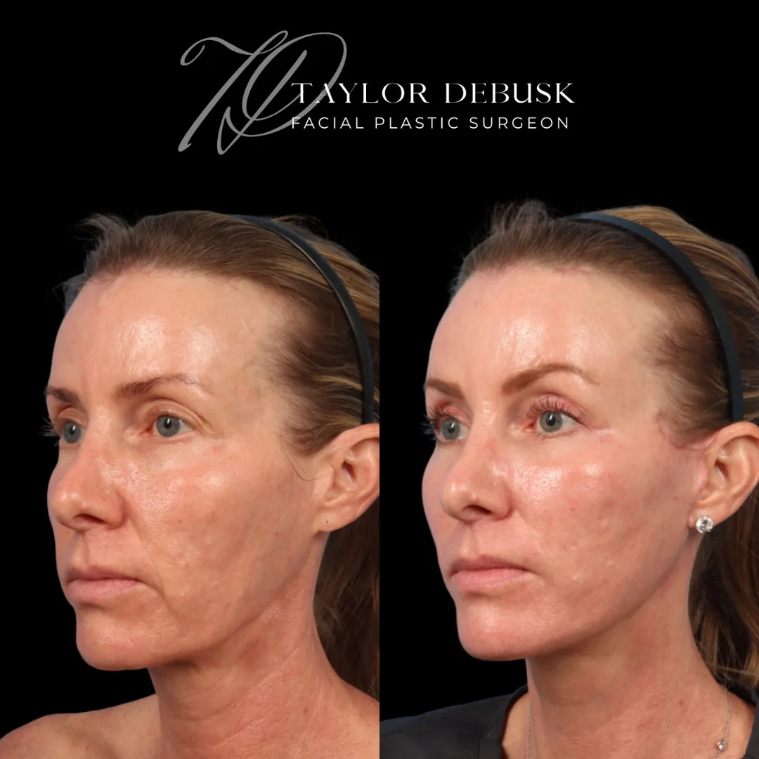 Before and after deep plane facelift — 45-year-old woman, three-quarter view, 1mo post-op by Dr. Taylor DeBusk