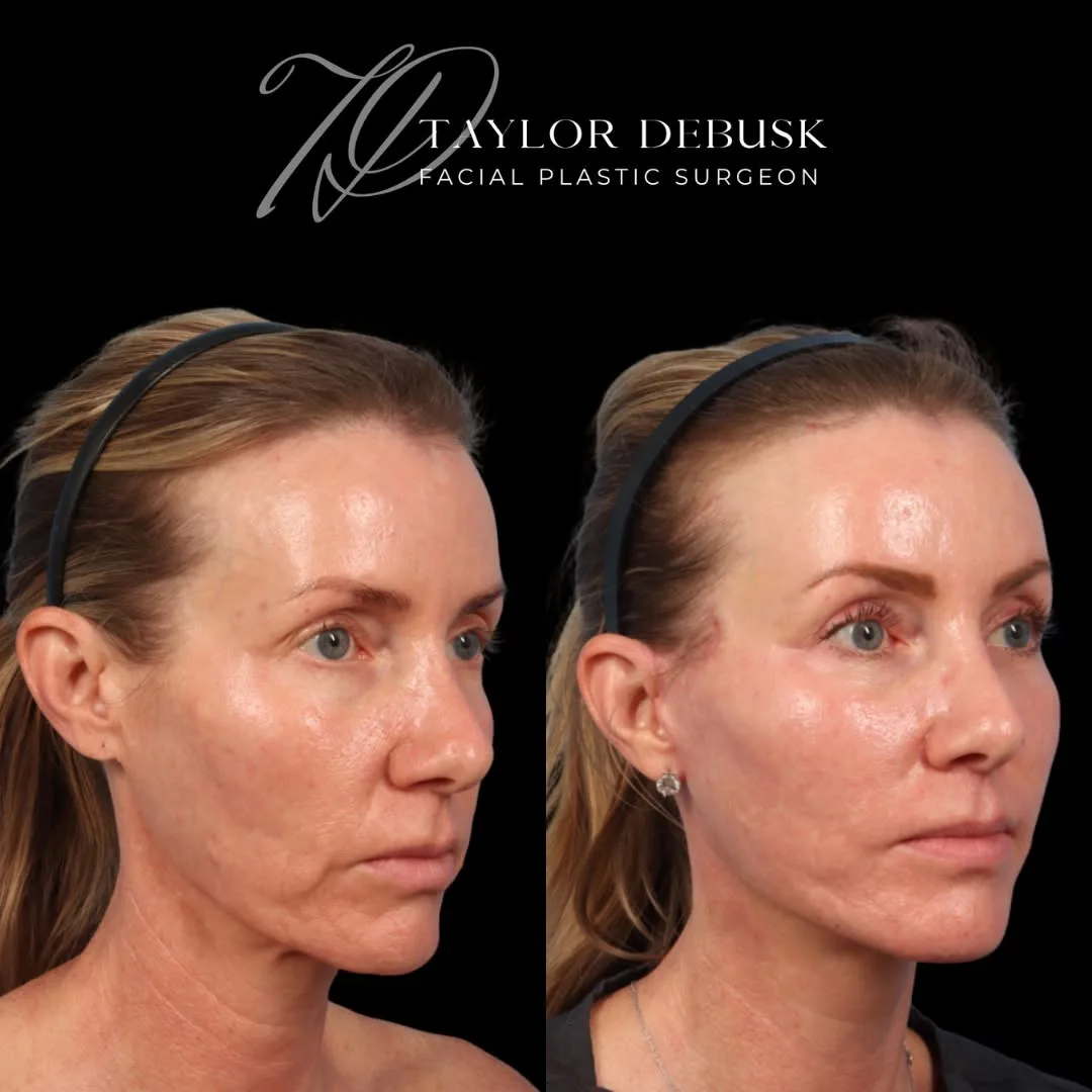 Before and after deep plane facelift — 45-year-old woman, three-quarter view, 1mo post-op by Dr. Taylor DeBusk